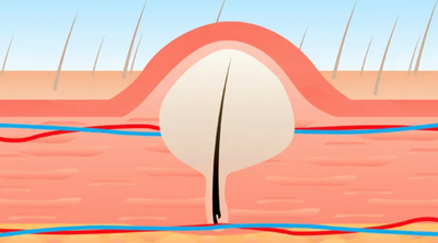 Lông mọc ngược và những cách trị