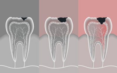 NHỮNG VẤN ĐỀ RĂNG MIỆNG THƯỜNG GẶP