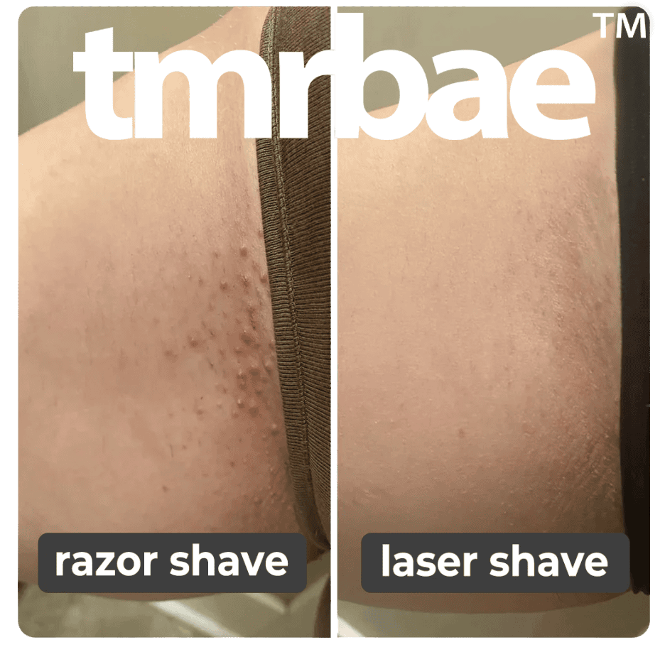Tmrbae™ NAKED IPL hair removal Gen 2 (990,000 xung)