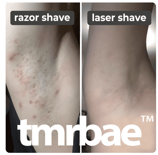Tmrbae™ NAKED IPL hair removal Gen 2 (990,000 xung)