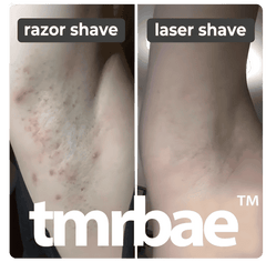 Tmrbae™ NAKED IPL hair removal Gen 2 (990,000 xung)